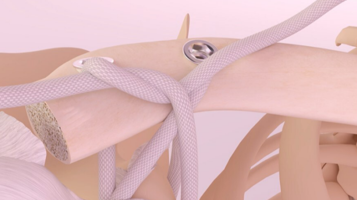 Movmedix gets FDA nod for third-gen synthetic shoulder implant