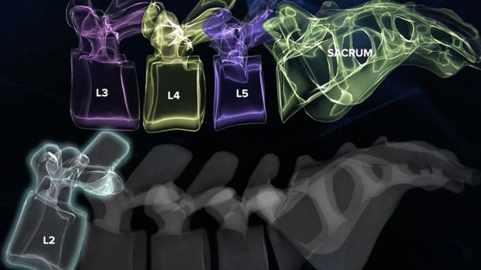 VB Spine completes acquisition of Augmedics' CT-to-fluoroscopy navigation technology
