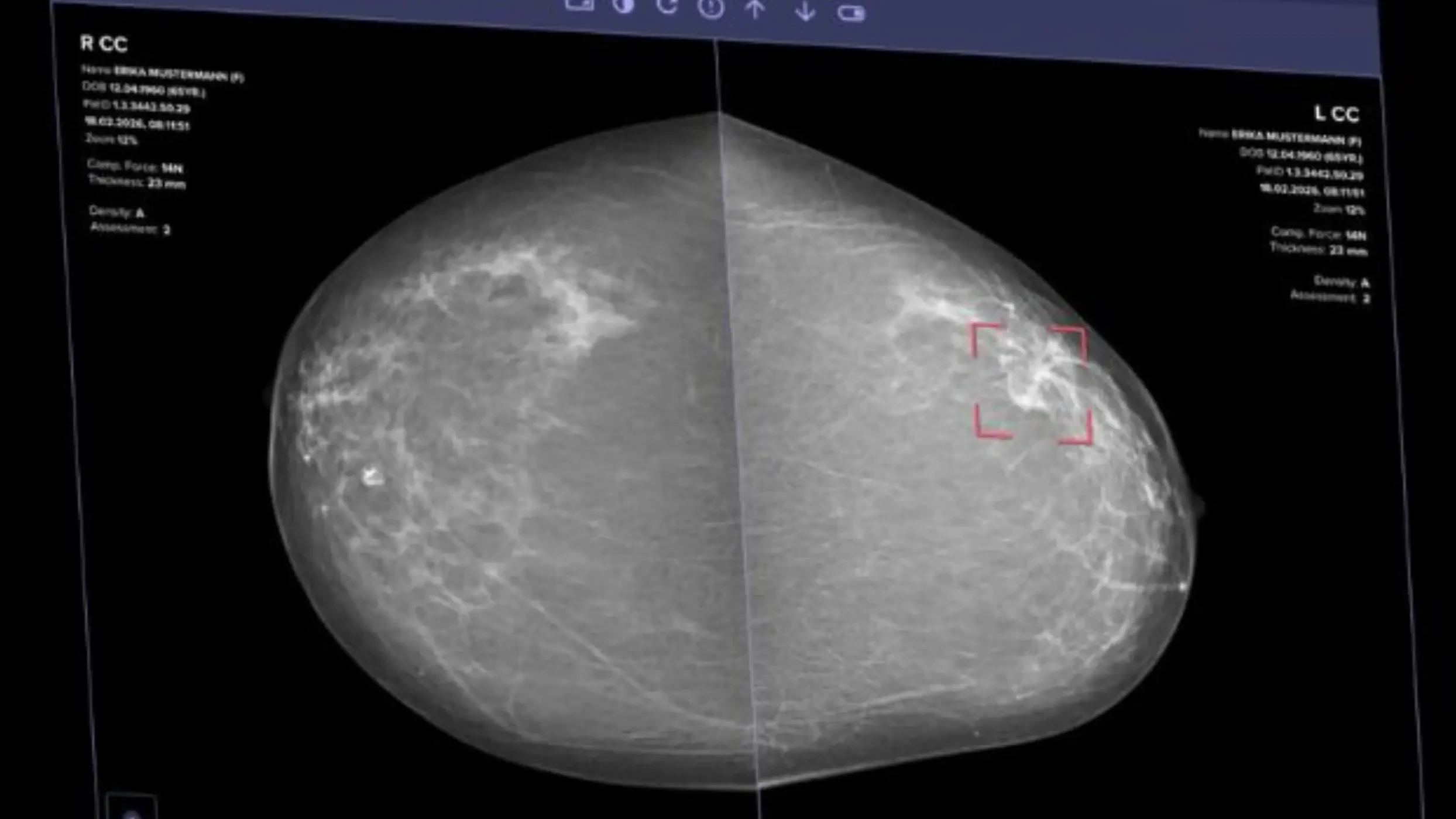 autonomous AI mammogram reporting