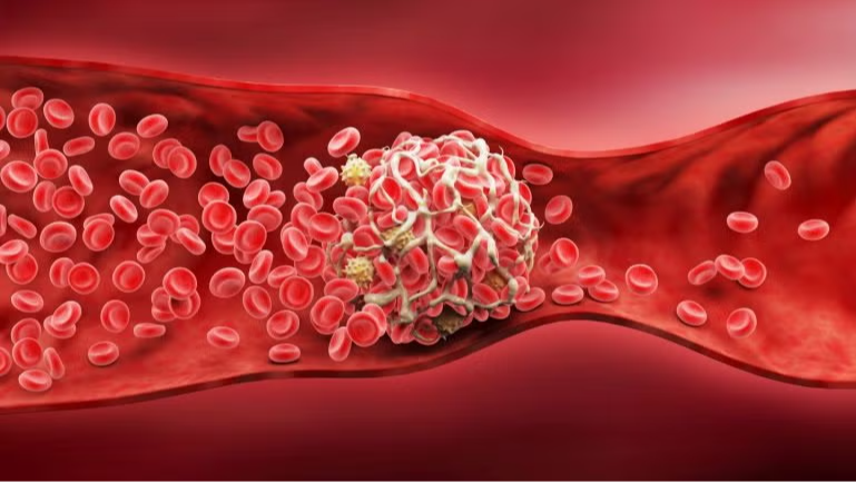 Anaconda Biomed stroke catheter
