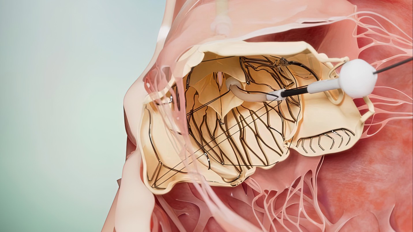Laplace Tricuspid Valve